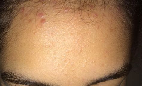 What Causes Acne Near Hairline